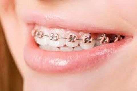 Lợi ích của việc điều trị chỉnh nha cho cả bố mẹ và con cái