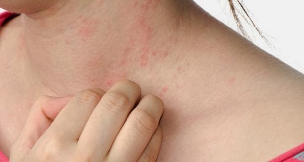 viêm da dị ứng