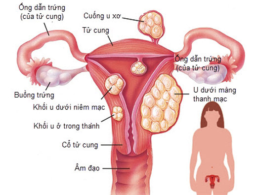 U Xơ Tử Cung