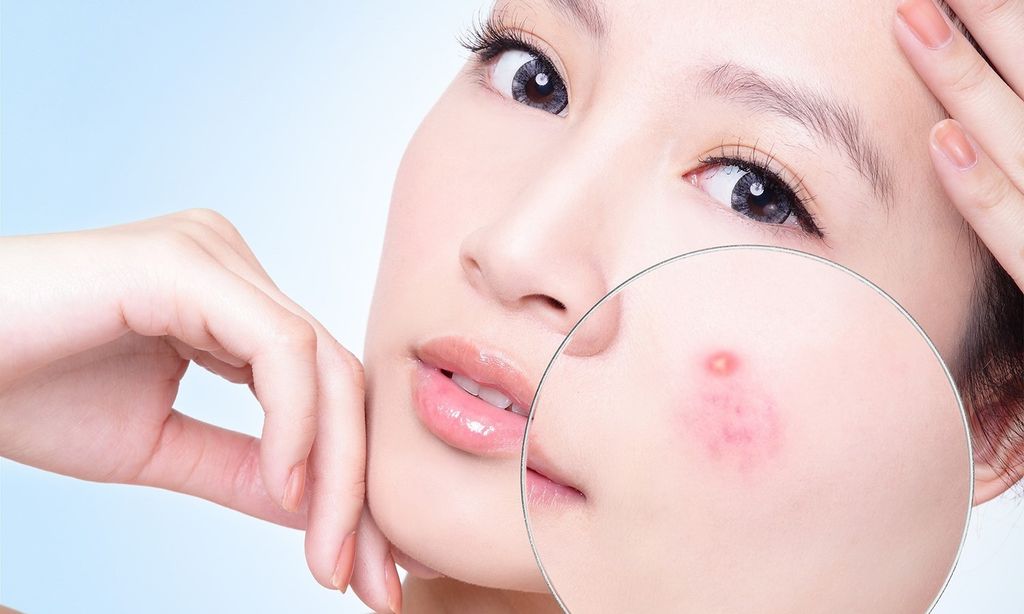 Lời nói chính xác về mụn trên cơ thể cần lưu tâm