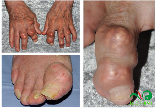cay no ngay dat tri gout