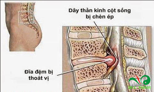 cay chia voi chua thoat vi dia dem 1