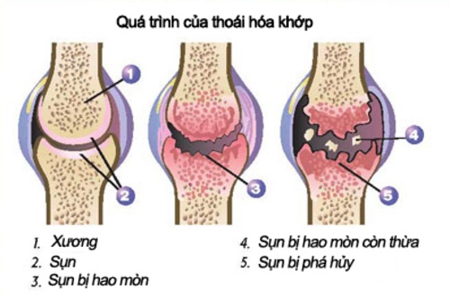qt-thoai-hoa-khop