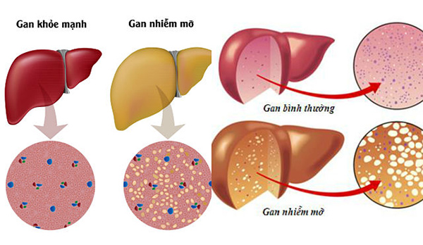 thoat-gan-nhiem-mo-nho-giai-doc-gan