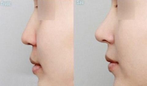 Nâng mũi tại Thẩm mỹ viện Châu Á