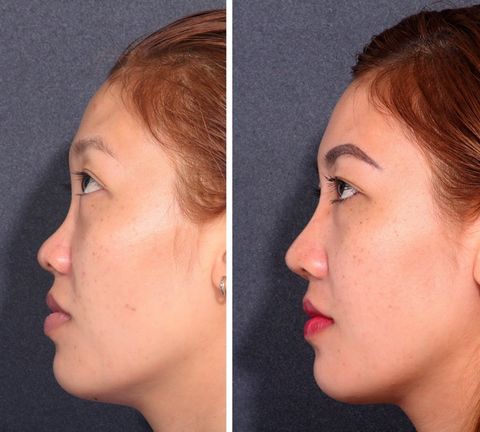 Nâng mũi tại Thẩm mỹ viện Châu Á