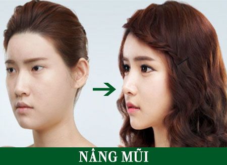 Nâng mũi tại Thẩm mỹ viện Châu Á