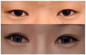 Kết quả bấm mi mắt Hàn Quốc