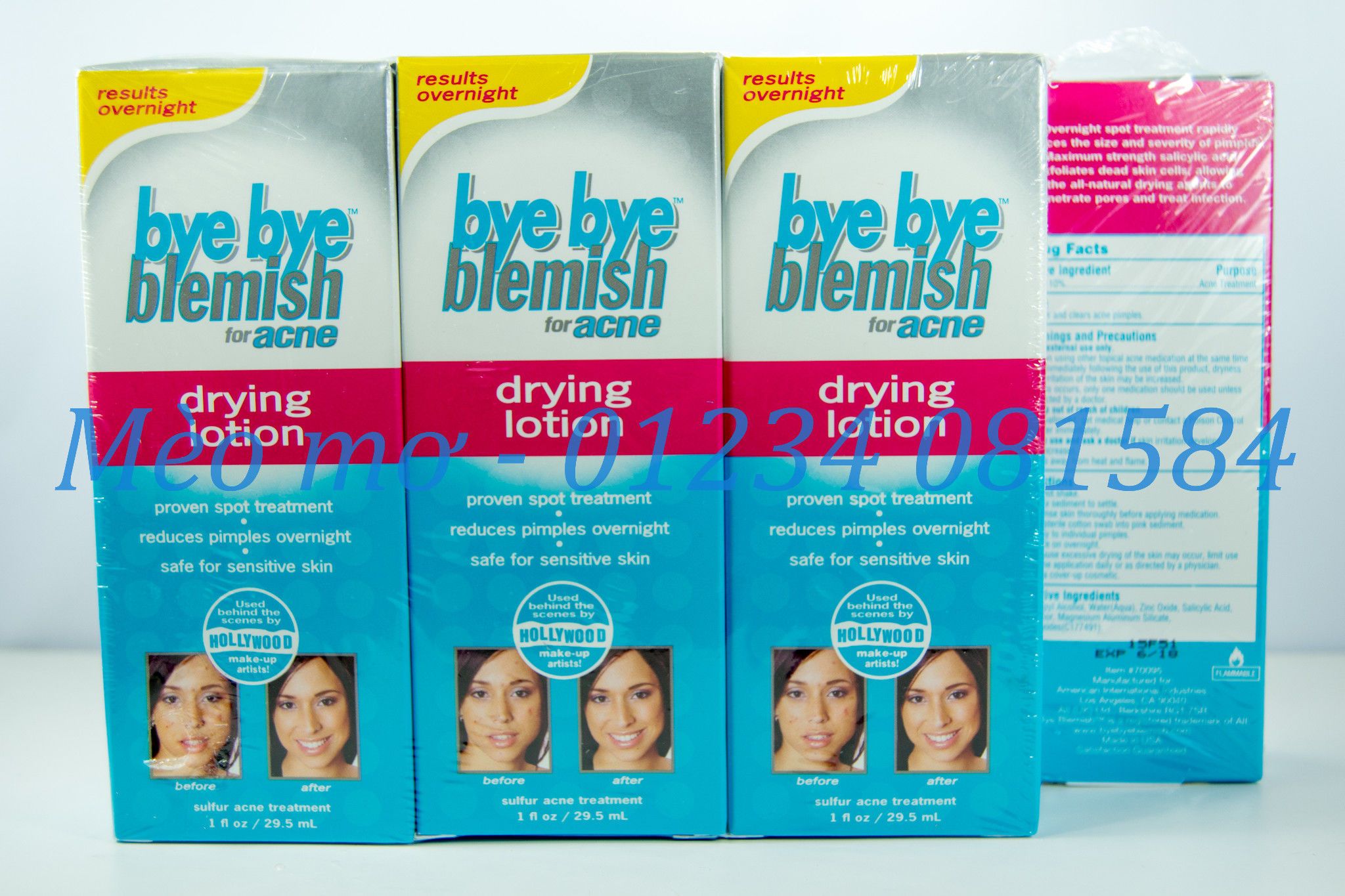 Bye Bye Blemish for acne - dry lotion -  29.5ml