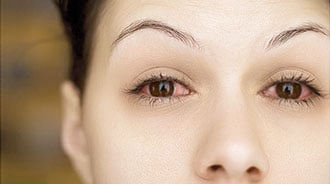 Đỏ mắt - Không chỉ do dùng kính áp tròng sai cách