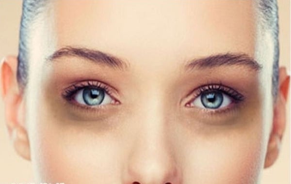 7 lý do ngạc nhiên khiến mắt bạn có quầng thâm